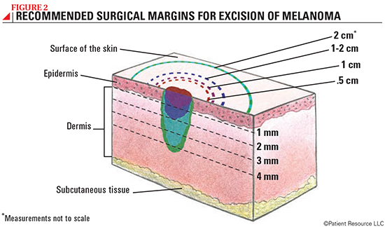 Melanoma Treatment